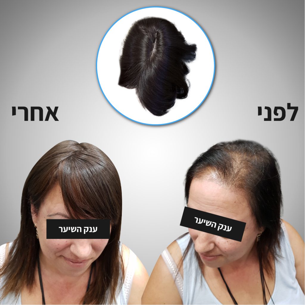 שיער דליל נשים