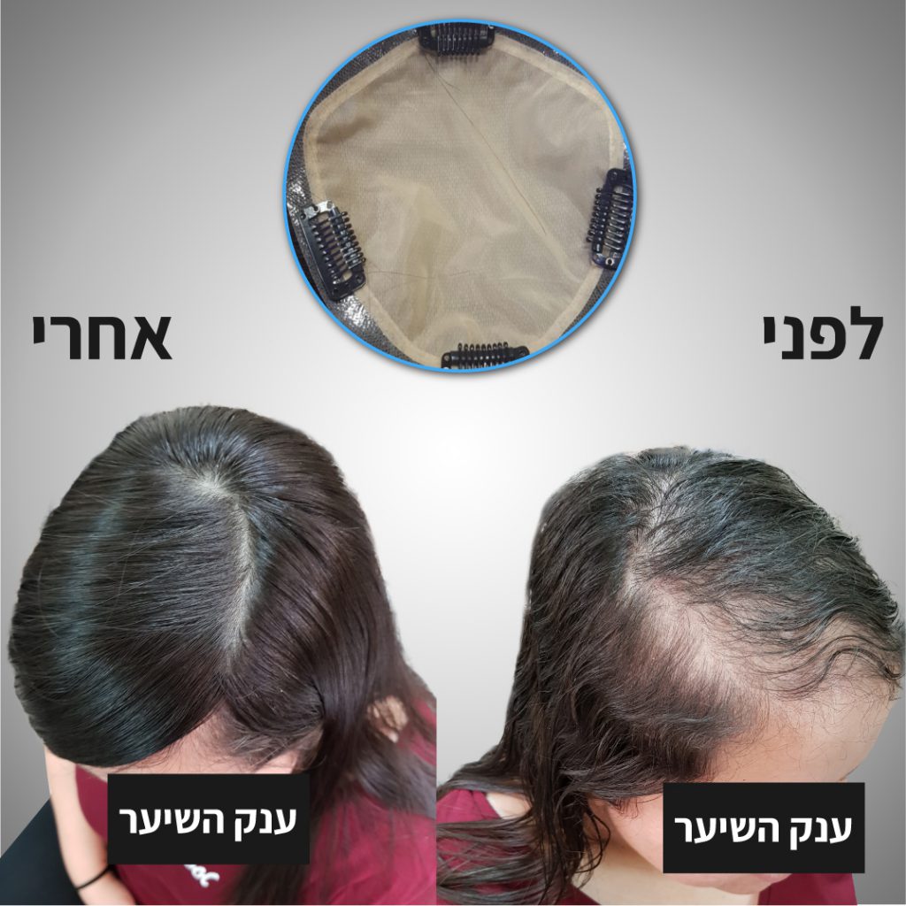 עיבוי שיער דליל