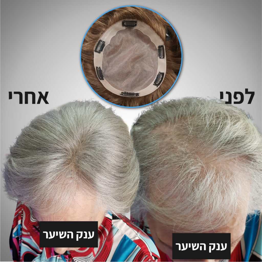 עיבוי שיער