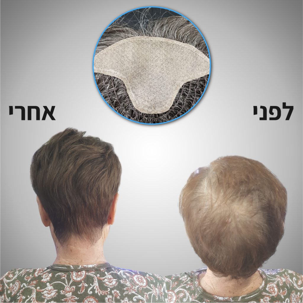 פתרון לשיער דליל